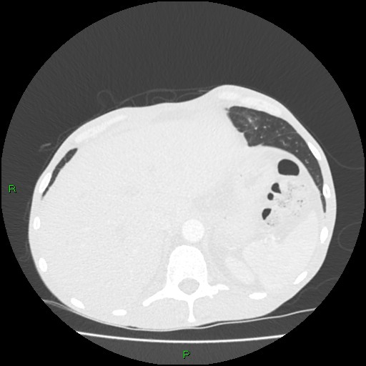 File:Acute right lung abscess (Radiopaedia 34806-36258 Axial lung window 173).jpg