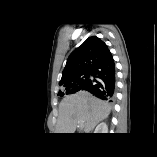 Acute segmental pulmonary emboli and pulmonary infarction (Radiopaedia 62264-70444 Sagittal C+ CTPA 22).jpg