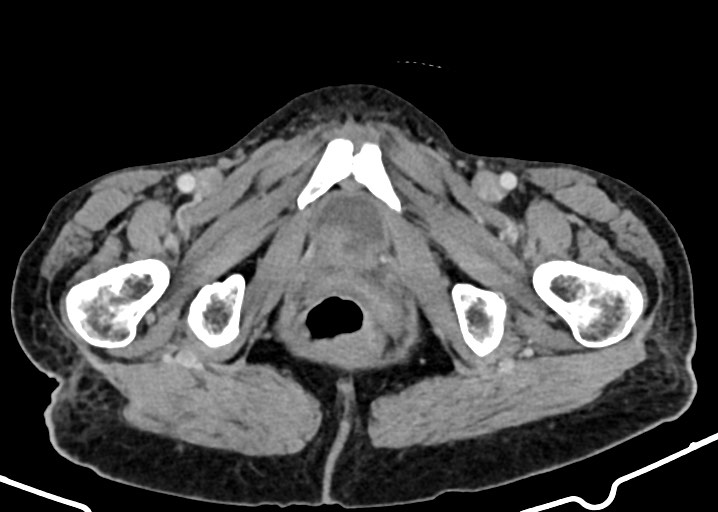 Acute small bowel (ileal) volvulus (Radiopaedia 71740-82139 Axial C+ portal venous phase 200).jpg