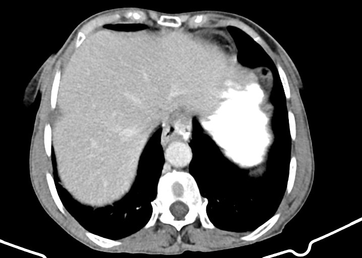 File:Acute small bowel (ileal) volvulus (Radiopaedia 71740-82139 Axial C+ portal venous phase 43).jpg