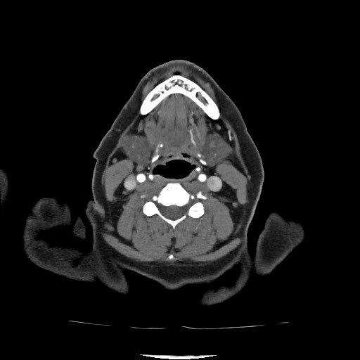 Acute subarachnoid hemorrhage and accessory anterior cerebral artery (Radiopaedia 69231-79009 Axial C+ arterial phase 50).jpg