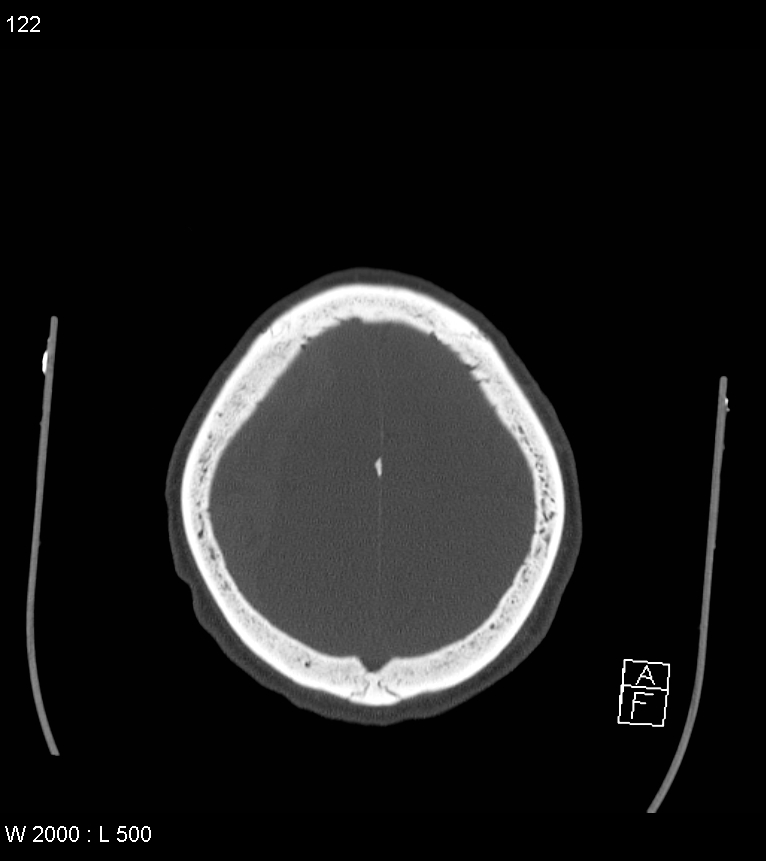 Acute subdural hematoma with myelofibrosis (Radiopaedia 52582-58494 Axial bone window 61).jpg