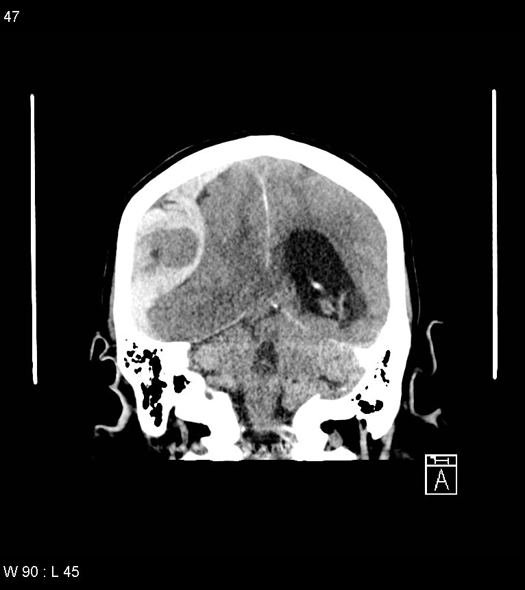 Acute subdural hematoma with myelofibrosis (Radiopaedia 52582-58494 Coronal non-contrast 38).jpg