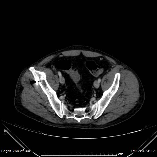 Acute superior mesenteric artery occlusion (Radiopaedia 43636-47060 Axial C+ portal venous phase 52).jpg