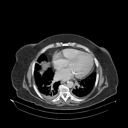 File:Acute superior mesenteric artery occlusion (Radiopaedia 51288-56960 Axial C+ portal venous phase 2).jpg