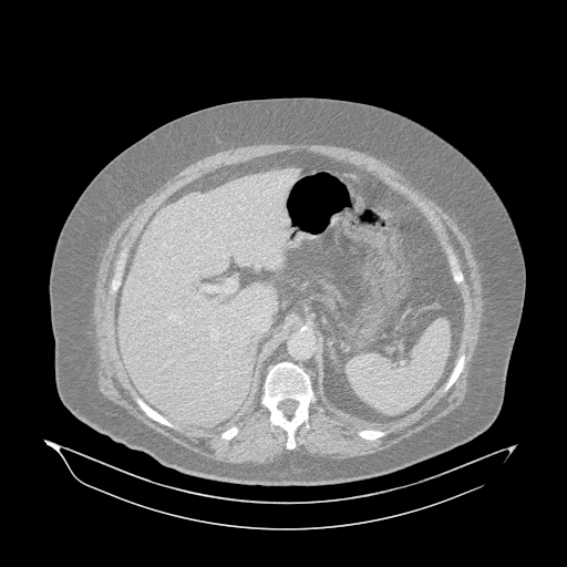 Acute superior mesenteric artery occlusion (Radiopaedia 51288-56960 Axial lung window 7).jpg