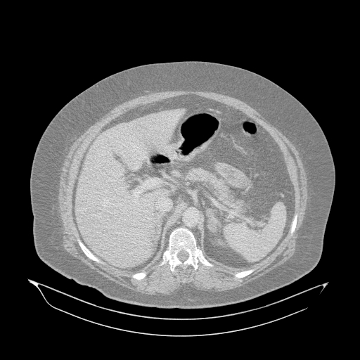 Acute superior mesenteric artery occlusion (Radiopaedia 51288-56960 Axial lung window 9).jpg