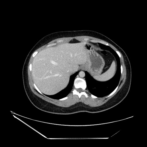 Acute uncomplicated appendicitis (Radiopaedia 73704-84499 Axial C+ portal venous phase 26).jpg