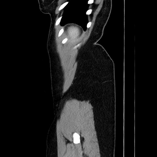 Acute uncomplicated appendicitis (Radiopaedia 73704-84499 Sagittal C+ portal venous phase 178).jpg