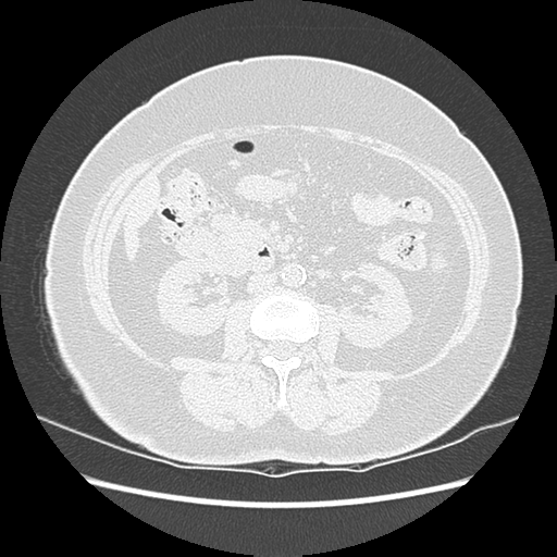 Adenocarcinoma in situ of lung (Radiopaedia 38685-40829 B 268).png