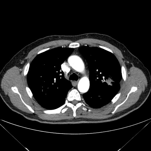 Adenocarcinoma of the lung (Radiopaedia 59871-67325 Axial C+ arterial phase 31).jpg