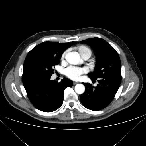 Adenocarcinoma of the lung (Radiopaedia 59871-67325 Axial C+ arterial phase 50).jpg