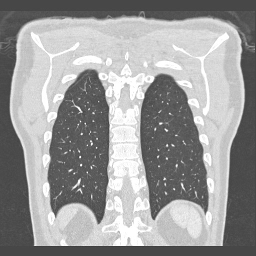 Adenocarcinoma of the lung (Radiopaedia 59871-67325 Coronal lung window 55).jpg