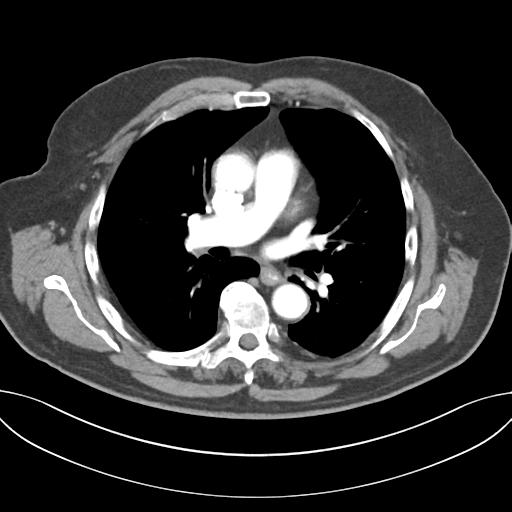Adenocarcioma of rectum- T1 lesion (Radiopaedia 36921-38547 Axial C+ arterial phase 28).png