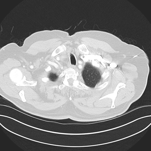 Adenocarcioma of rectum- T1 lesion (Radiopaedia 36921-38547 Axial lung window 9).png