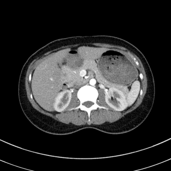File:Adenocystic carcinoma of the trachea (Radiopaedia 47677-52525 Axial C+ arterial phase 85).jpg