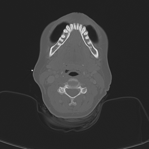 Adenoid cystic tumor of palate (Radiopaedia 46980-51518 Axial bone window 40).png