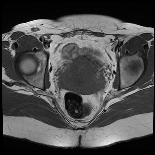 File:Adenomyosis-scar endometriosis (Radiopaedia 65863-75022 Axial T1 20).jpg