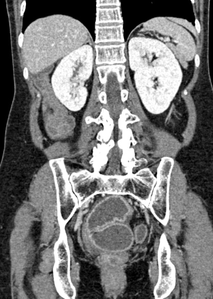 Adhesional small bowel obstruction (Radiopaedia 48397-53305 Coronal C+ portal venous phase 249).jpg