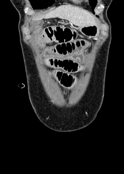 Adhesional small bowel obstruction (Radiopaedia 48397-53305 Coronal C+ portal venous phase 49).jpg