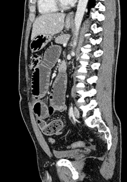 Adhesional small bowel obstruction (Radiopaedia 58900-66131 Sagittal C+ portal venous phase 144).jpg