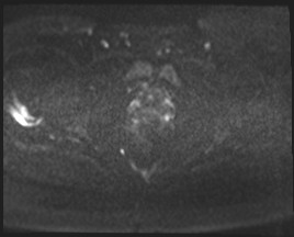 Adnexal multilocular cyst (O-RADS US 3- O-RADS MRI 3) (Radiopaedia 87426-103754 Axial DWI 81).jpg
