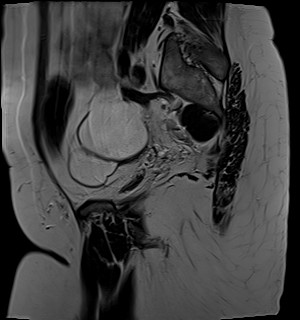 File:Adnexal multilocular cyst (O-RADS US 3- O-RADS MRI 3) (Radiopaedia 87426-103754 Sagittal T2 20).jpg