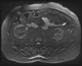 Adrenal cortical carcinoma (Radiopaedia 64017-72770 Axial DWI 114).jpg