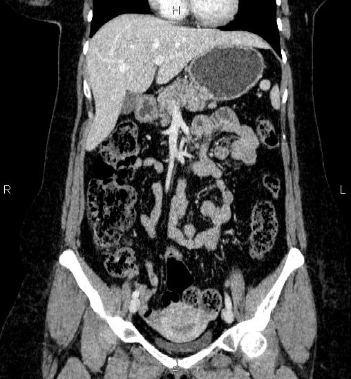 Adrenal cortical carcinoma (Radiopaedia 84882-100379 Coronal C+ portal venous phase 25).jpg