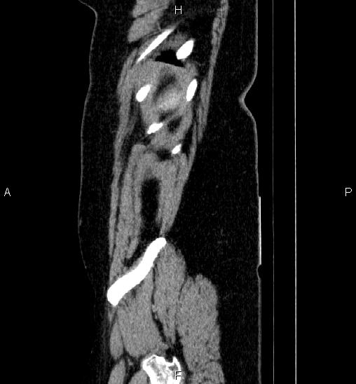 Adrenal cortical carcinoma (Radiopaedia 84882-100379 Sagittal C+ portal venous phase 82).jpg