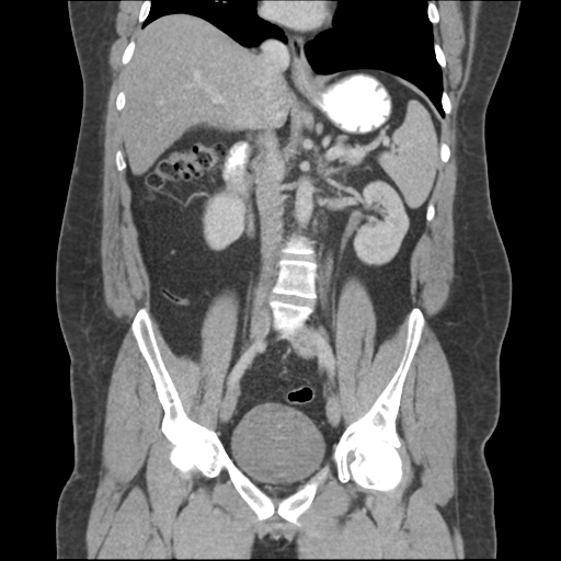 Adrenal cyst (Radiopaedia 45625-49776 Coronal C+ portal venous phase 41).png
