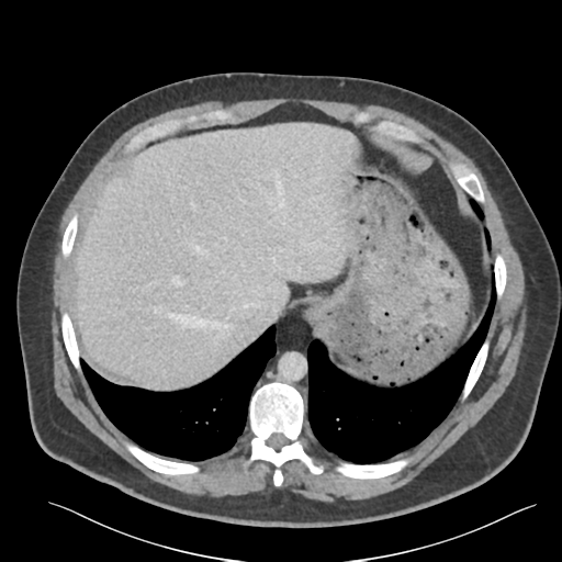 File:Adrenal cyst (Radiopaedia 45625-49777 Axial C+ portal venous phase 21).png