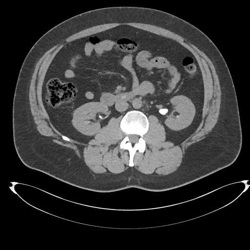 Adrenal cyst (Radiopaedia 45625-49778 Axial non-contrast 57).png