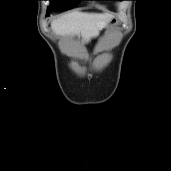 Adrenal cystic lymphangioma (Radiopaedia 83161-97534 Coronal C+ portal venous phase 10).jpg