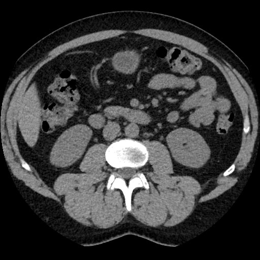 Adrenal gland trauma (Radiopaedia 81351-95079 Axial non-contrast 53).jpg