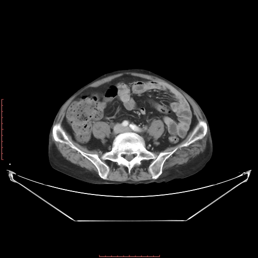 Adrenal hemangioma (Radiopaedia 68923-78668 Axial C+ portal venous phase 49).jpg