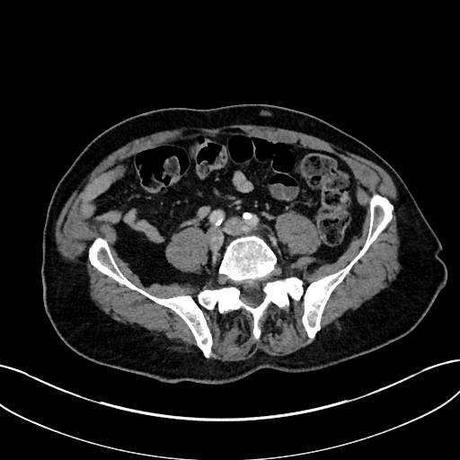 Adrenal lymphoma (Radiopaedia 73730-84529 Axial C+ portal venous phase 85).jpg