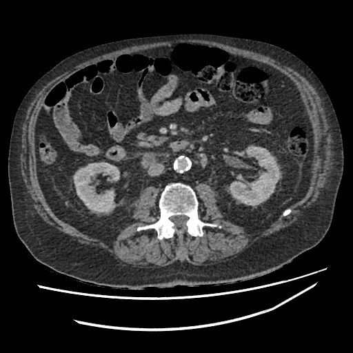 Adrenal lymphoma (Radiopaedia 84145-99415 Axial C+ portal venous phase 65).jpg