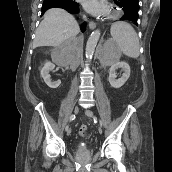 Adrenal lymphoma (Radiopaedia 84145-99415 Coronal C+ portal venous phase 52).jpg