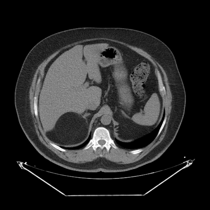 Adrenal myelolipoma (Radiopaedia 26278-26407 Axial non-contrast 14).jpg