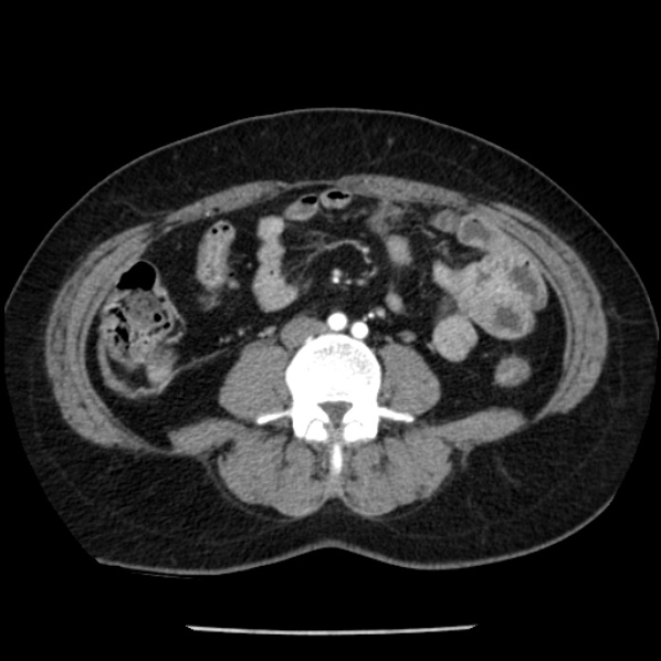 Adrenal myelolipoma (Radiopaedia 43401-46759 Axial C+ arterial phase 61).jpg