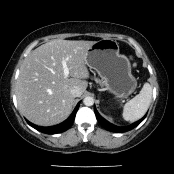 Adrenal myelolipoma (Radiopaedia 43401-46759 Axial C+ portal venous phase 18).jpg