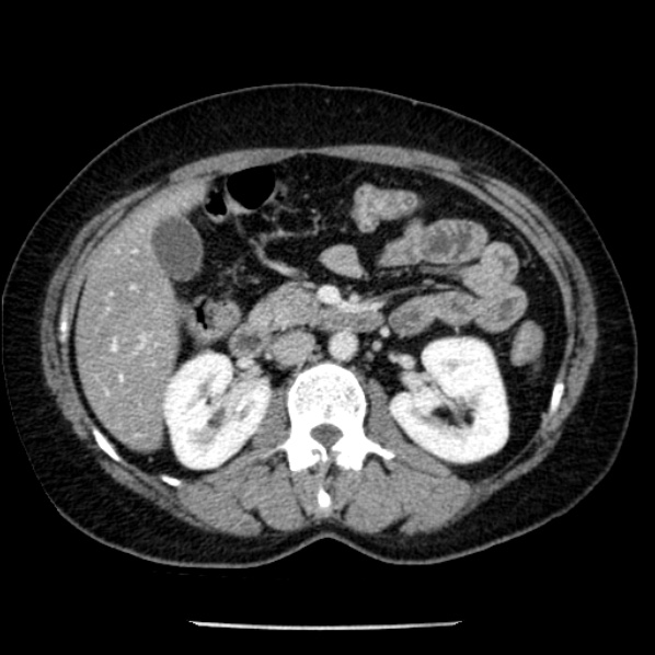 Adrenal myelolipoma (Radiopaedia 43401-46759 Axial C+ portal venous phase 35).jpg