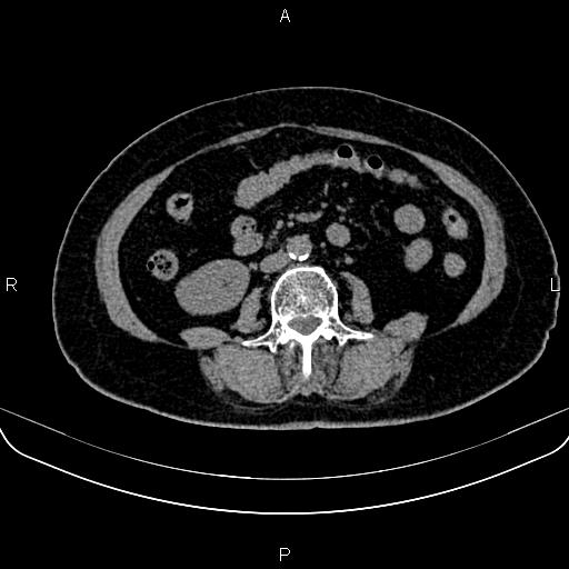 Adrenal myelolipoma (Radiopaedia 82742-96986 Axial non-contrast 88).jpg