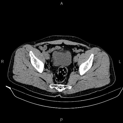 Adrenal myelolipoma (Radiopaedia 87794-104246 Axial non-contrast 92).jpg