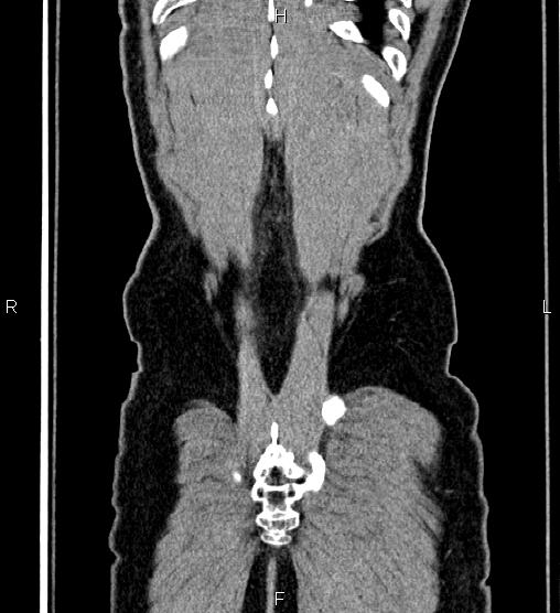 Adrenal myelolipoma (Radiopaedia 87794-104246 Coronal renal cortical phase 65).jpg
