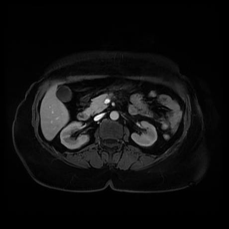 Adrenal myelolipoma - MRI (Radiopaedia 83249-97646 T1 fat sat arterial phase 45).jpg