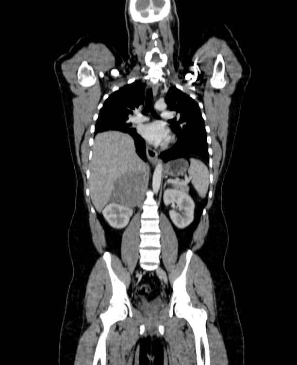 Adrenocortical carcinoma (Radiopaedia 80134-93438 Coronal C+ portal venous phase 100).jpg