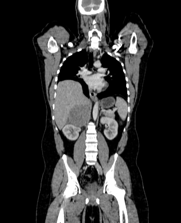 Adrenocortical carcinoma (Radiopaedia 80134-93438 Coronal C+ portal venous phase 98).jpg