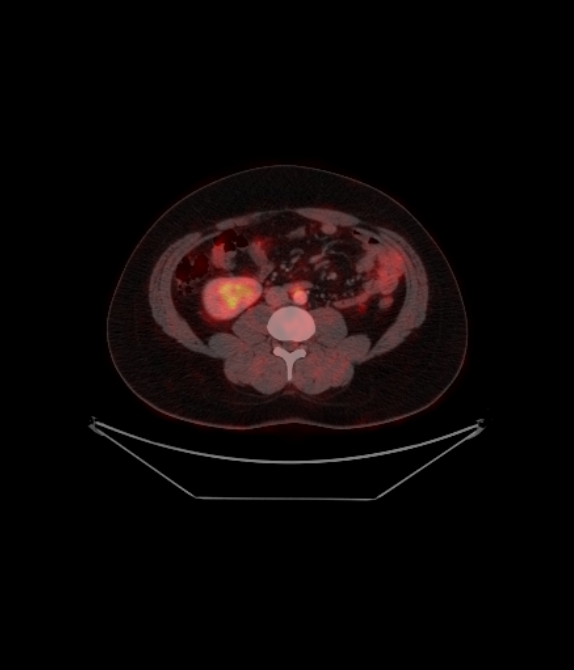 Adrenocortical carcinoma (Radiopaedia 80134-93440 ِAxial 193).jpg